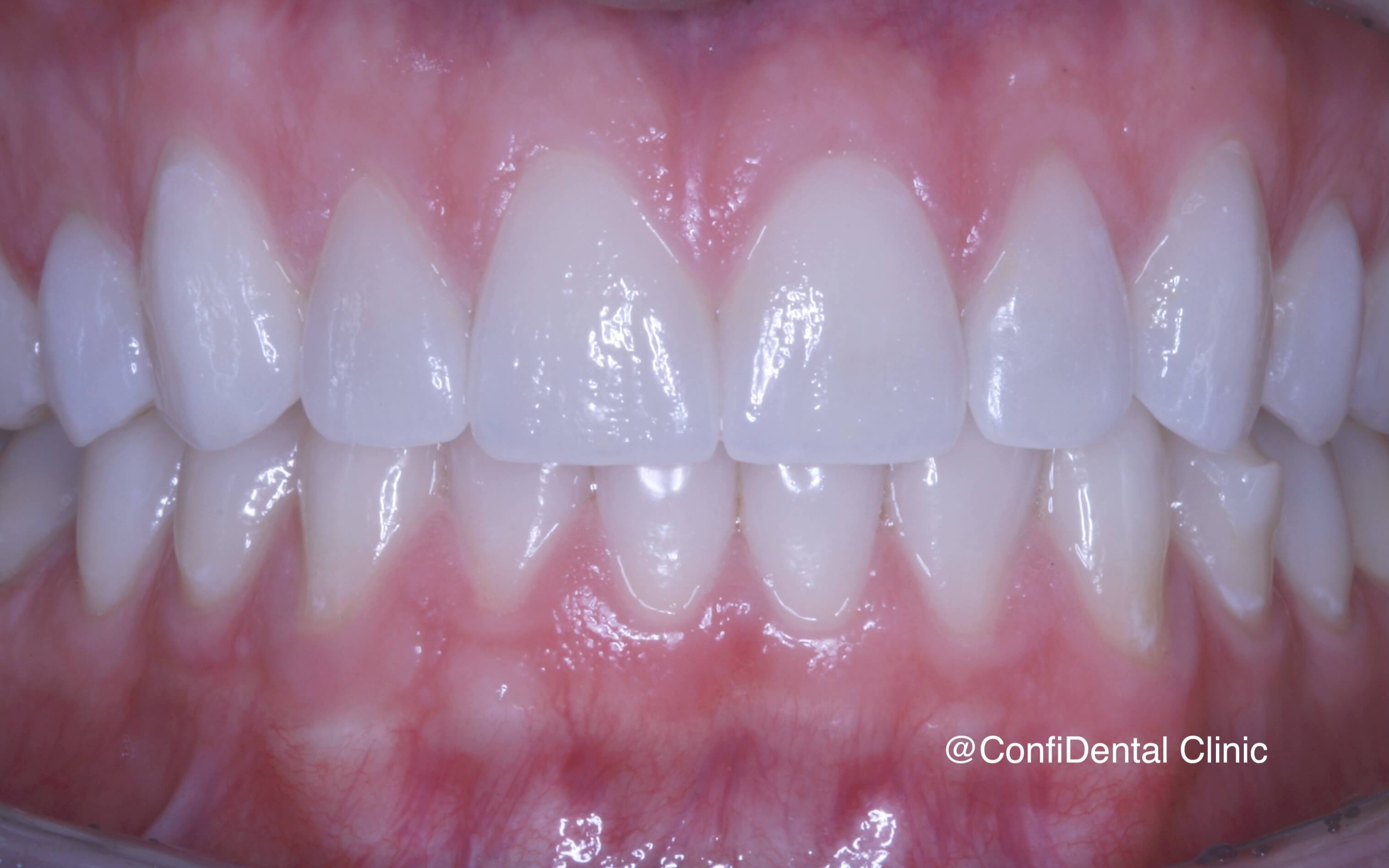 After treatment