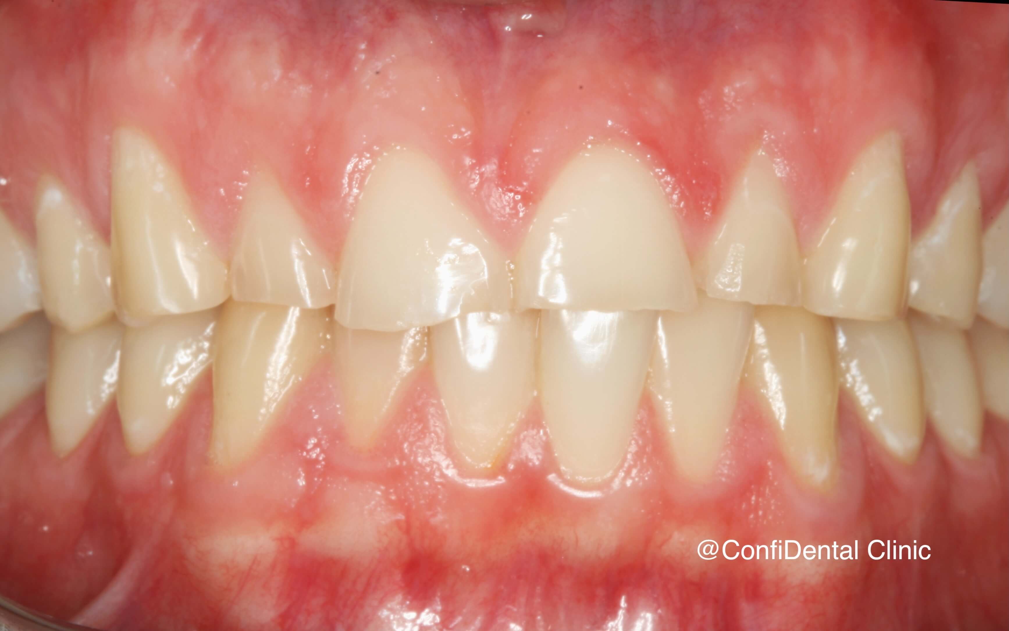 Before treatment