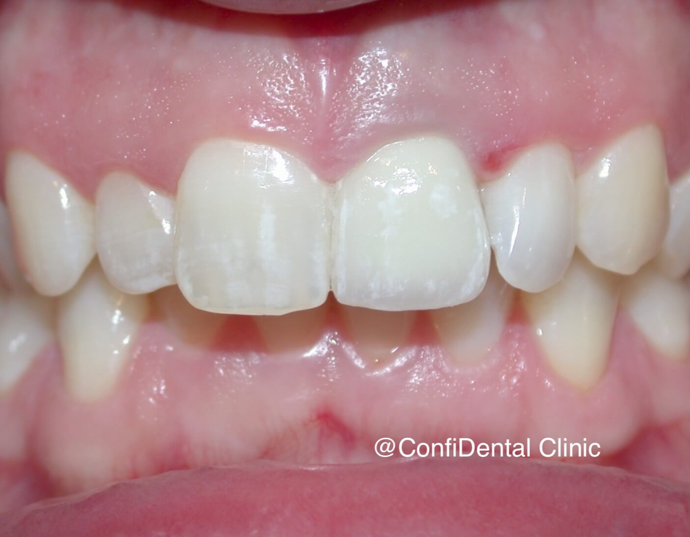 After treatment