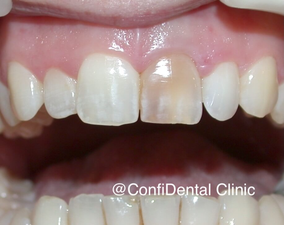Before treatment