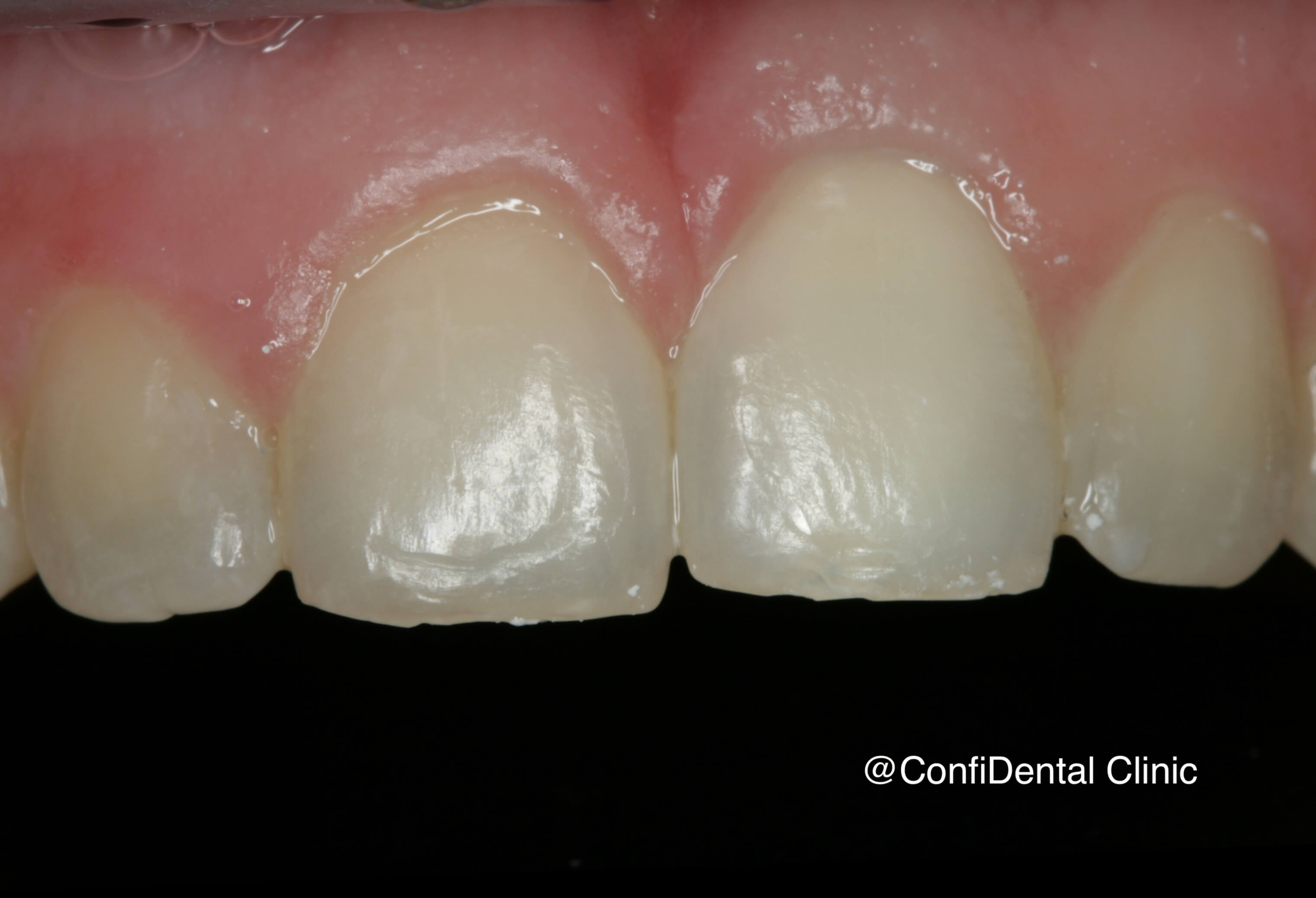 After treatment
