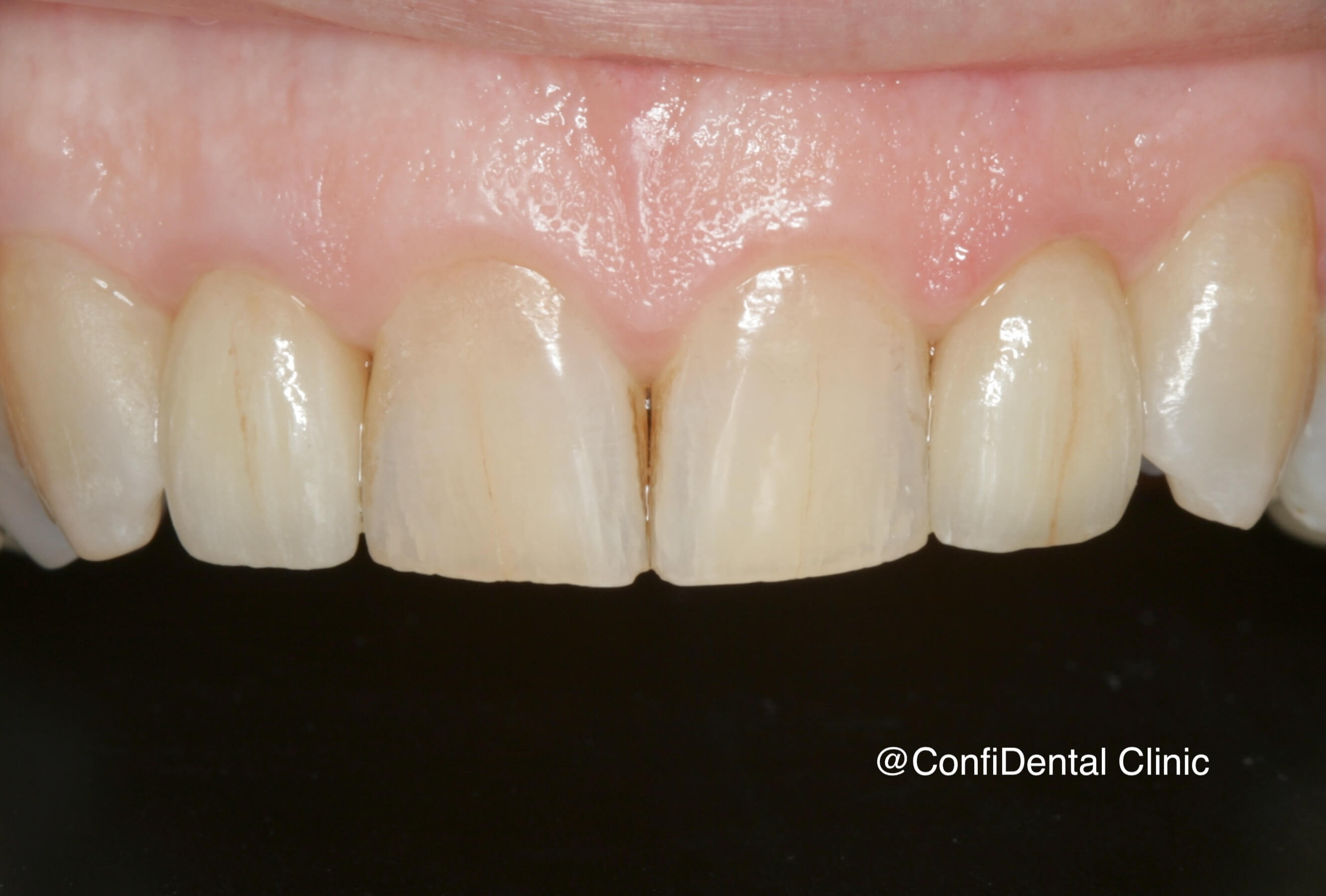 After treatment