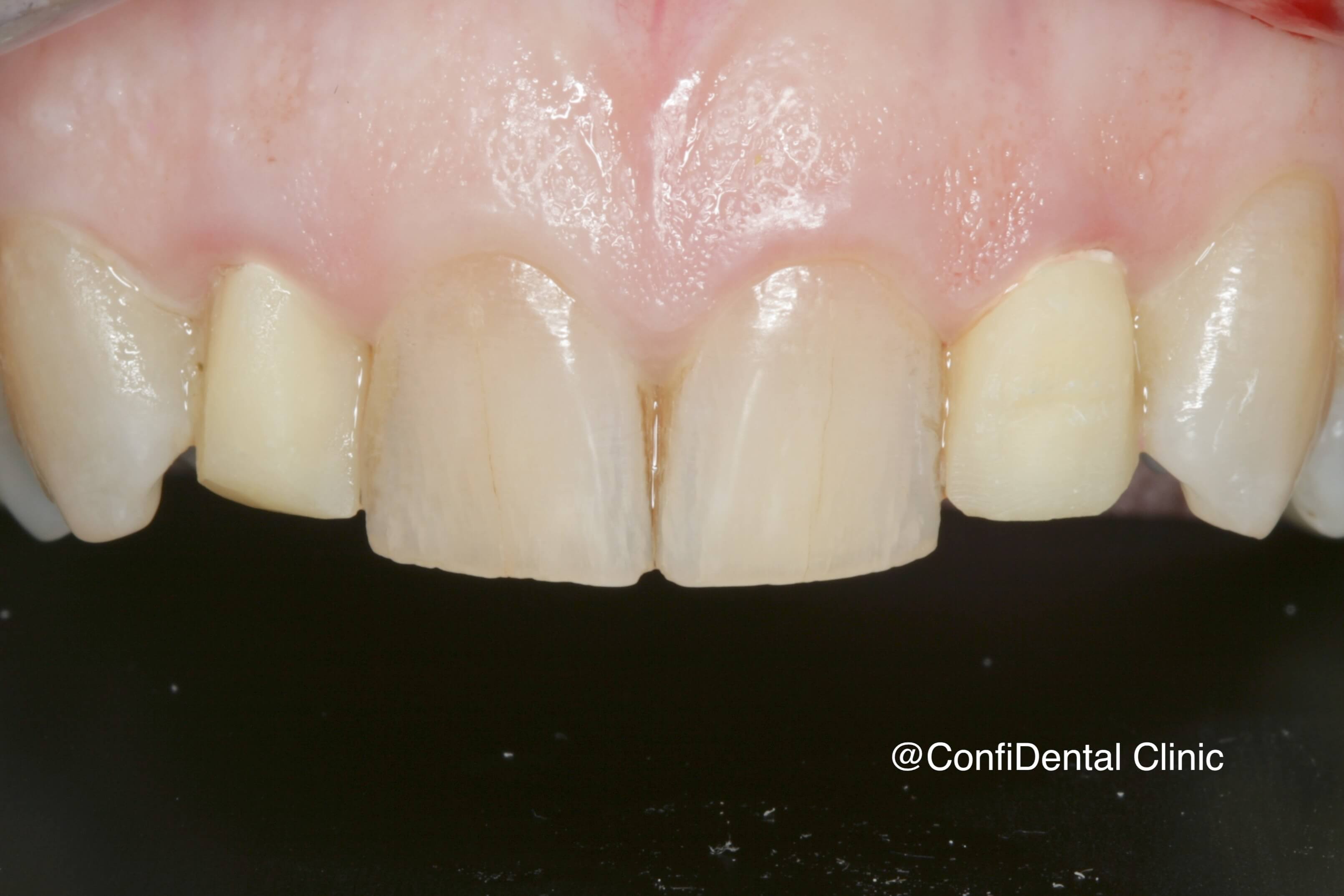 Before treatment