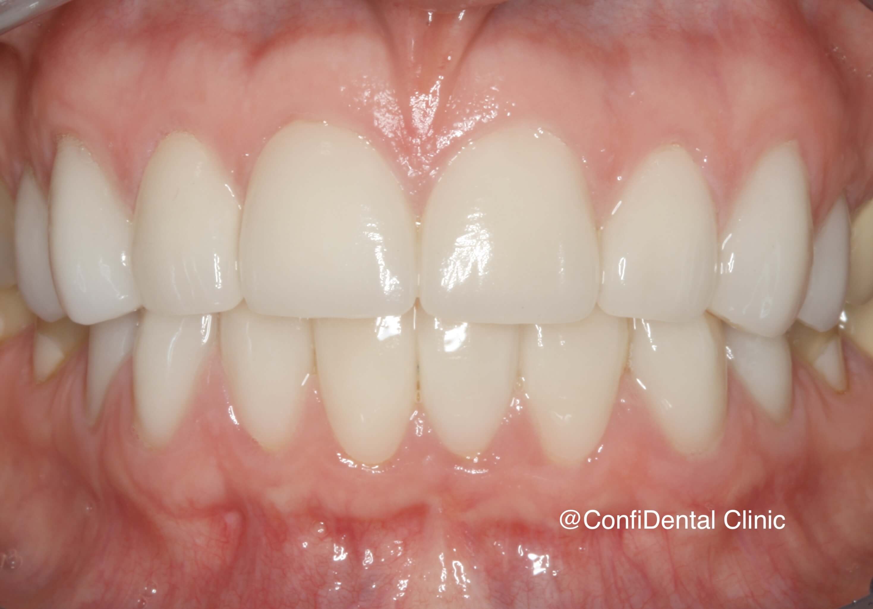 After treatment