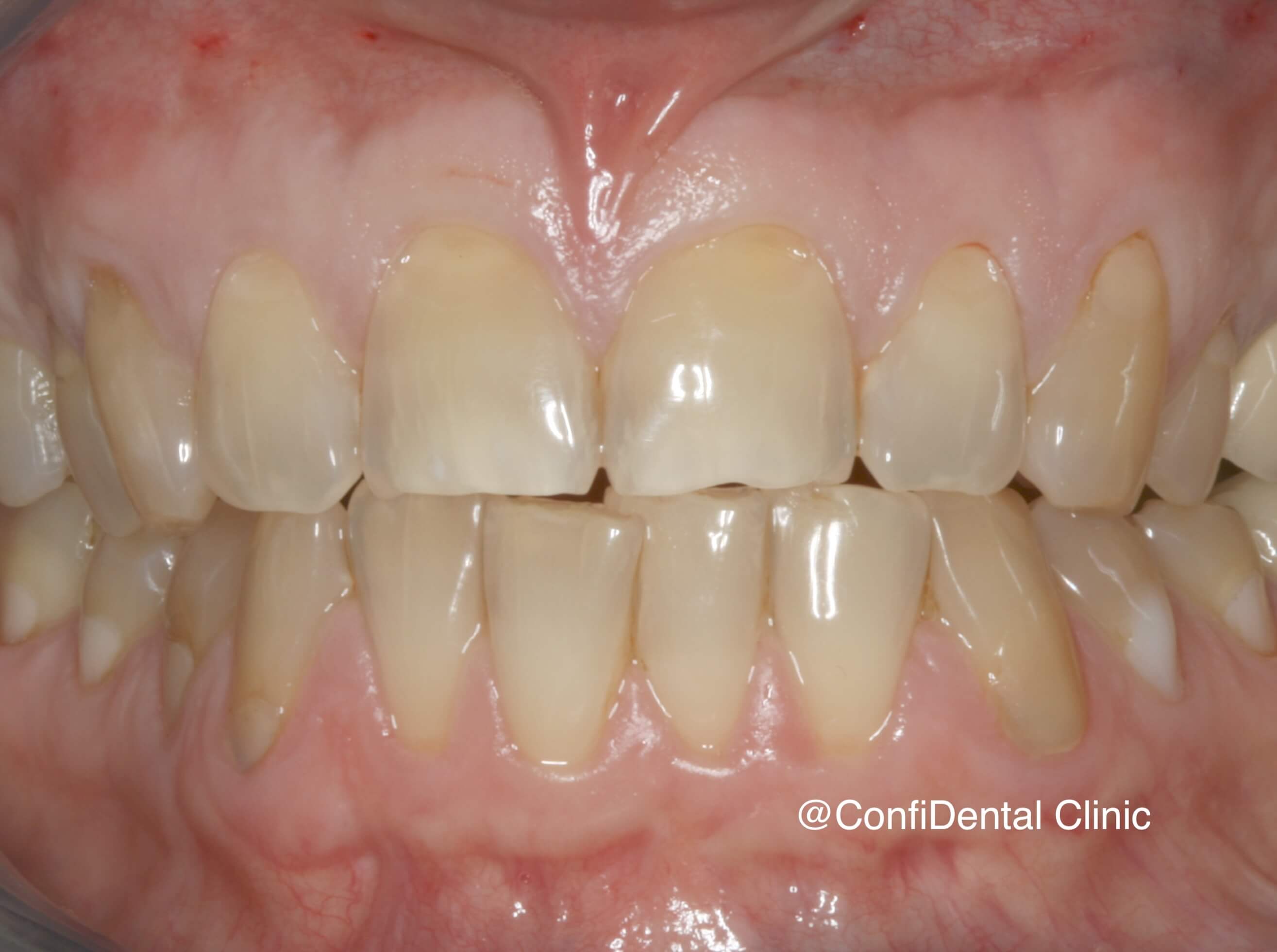 Before treatment