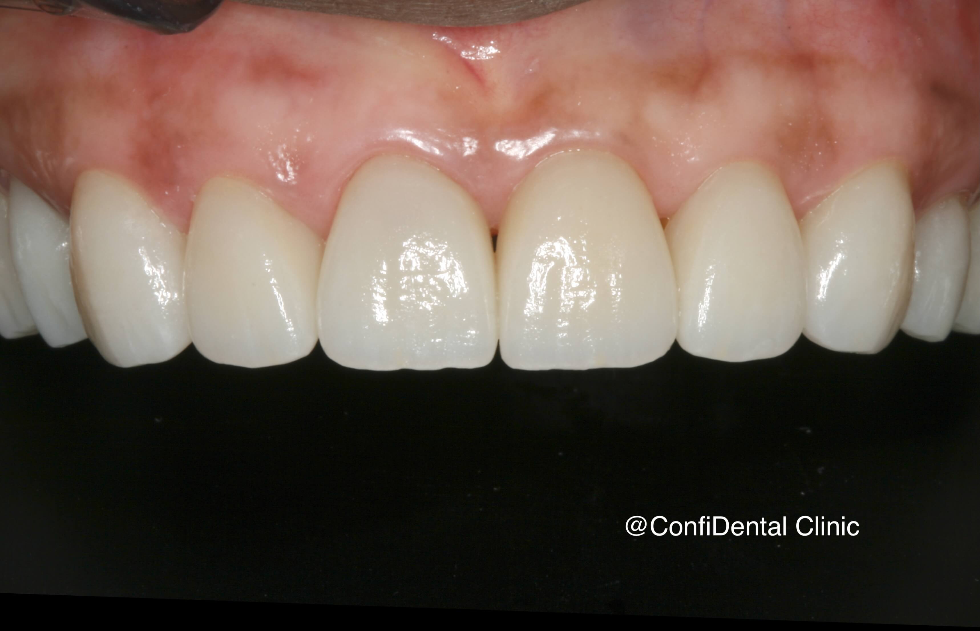 After treatment