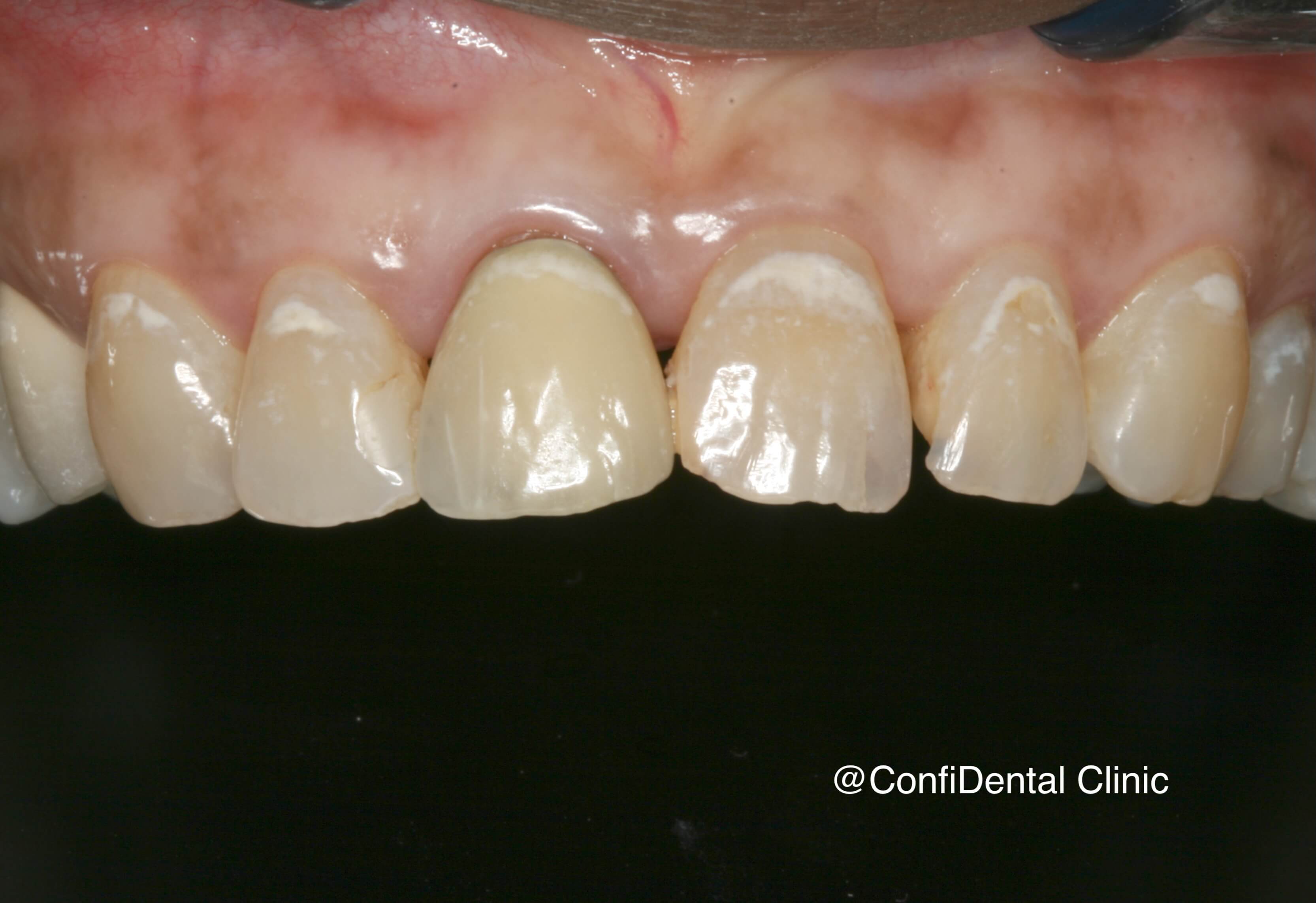 Before treatment