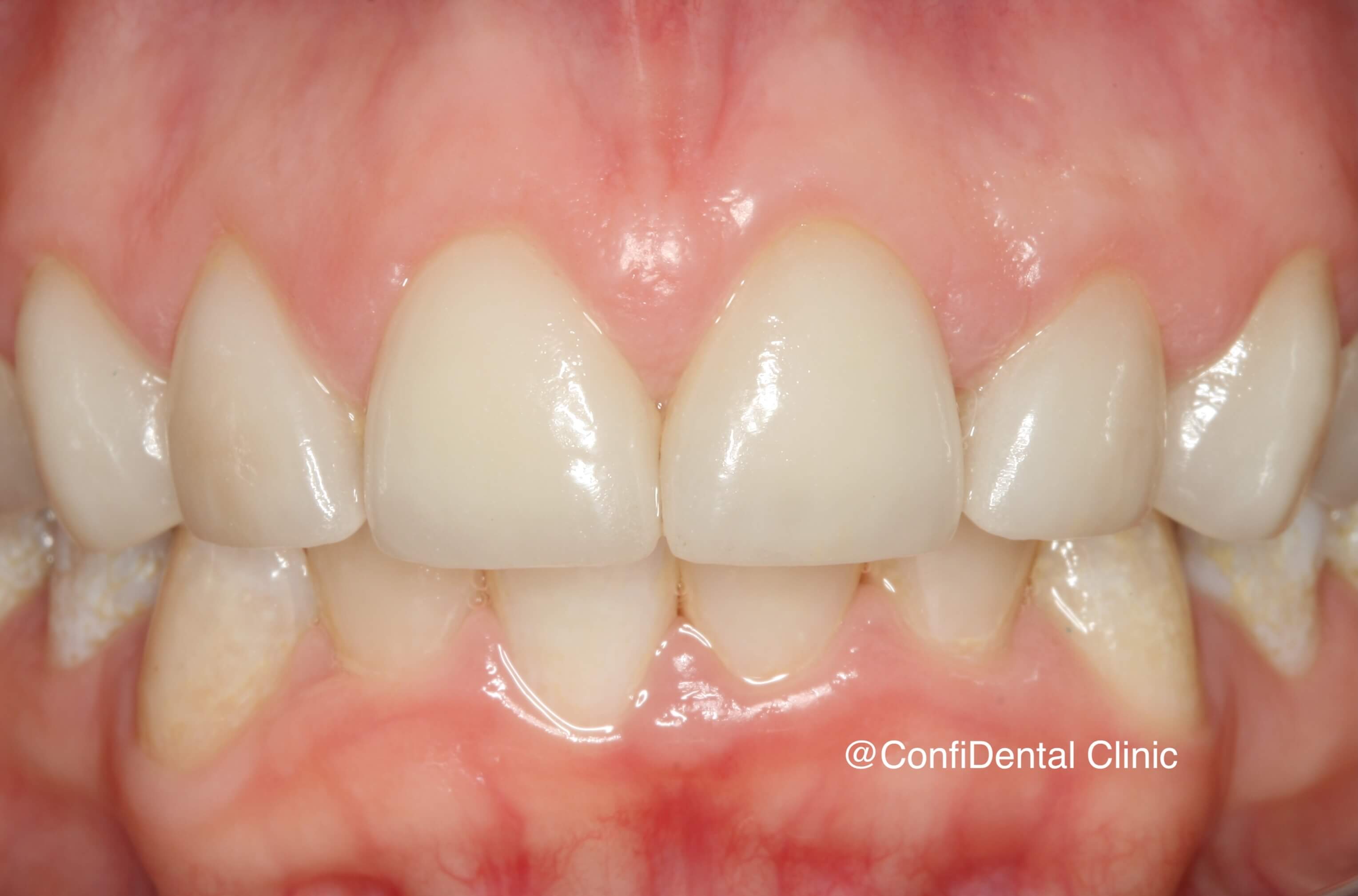 After treatment