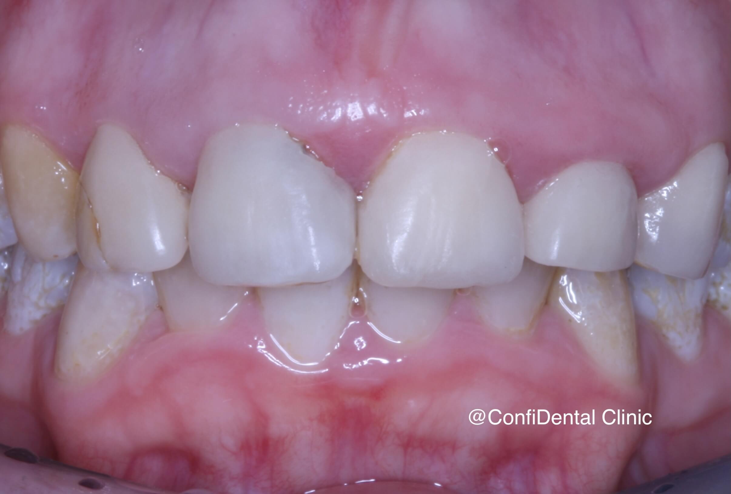 Before treatment